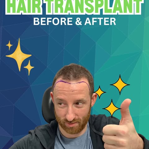 Restoring confidence — one graft at a time! ✨

In this case, I performed an FUE hair transplant to r