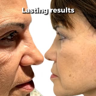 This facelift helped restore a smoother, more youthful appearance with natural-looking, lasting resu