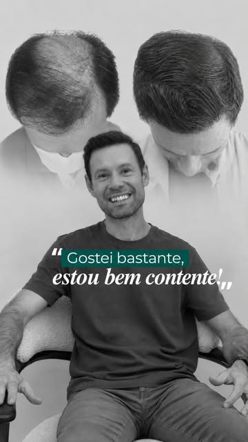 Quando a calvície começa a incomodar, muitas vezes não é apenas o cabelo que muda. A forma como a pe