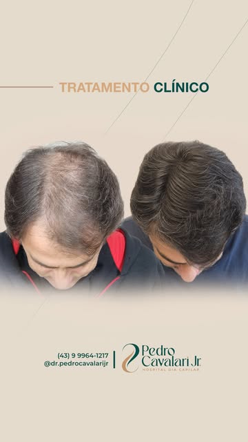 Você tem certeza de que precisa de um transplante capilar?

Esse paciente, de 50 anos, chegou até mi
