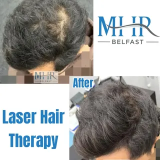 Healthy hair and growth depends on healthy follicles.

Laser Hair Therapy uses low-level light energ