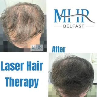 Thinking about your hair thinning, but not interested in surgery? You're not alone.

Many of our cli