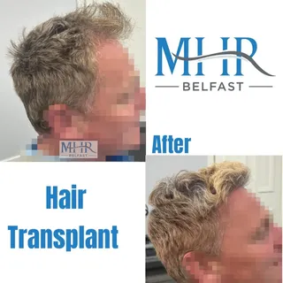 A new hairline. A natural result. A whole new level of confidence.

Every hair transplant is designe