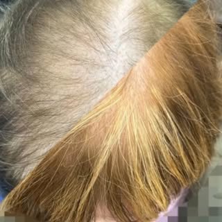 The difference in this parting speaks for itself 👀✨

From thinning to visibly fuller looking hair

