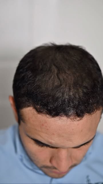 No es tener más cabello… es lograr que visualmente se vea mucho más denso. 🔥

Este antes y después 