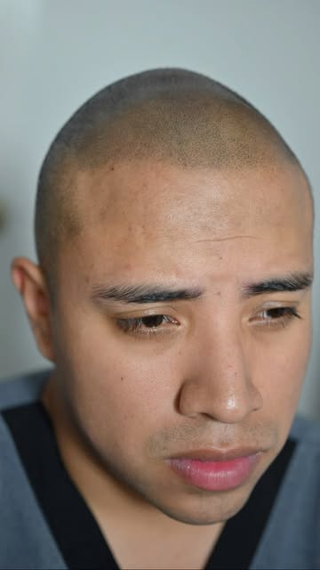 “Esto no es photoshop 😳 Antes y después real de micropigmentación capilar. Recupera tu densidad sin