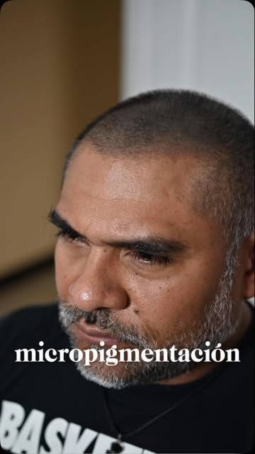 “Otro cambio real ✨ Antes y después de micropigmentación capilar: densidad recuperada sin cirugía. T
