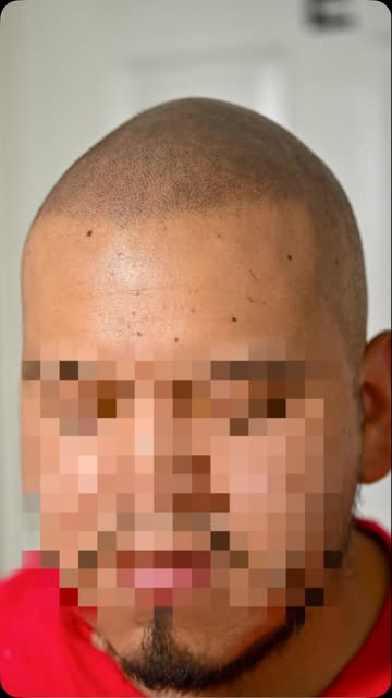 “No lo vas a creer 👀 Otro antes y después real de micropigmentación capilar. Densidad recuperada, s