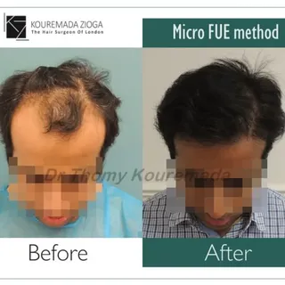 👉Bring your Dream Hair to Reality.
👉MicroFUE method performed by Dr.Thomy Kouremada .

www.london-