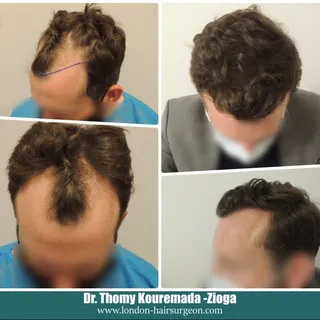 💥“Not just a hair transplant—it's a confidence transplant!”

💥“You can’t stop the clock, but you c