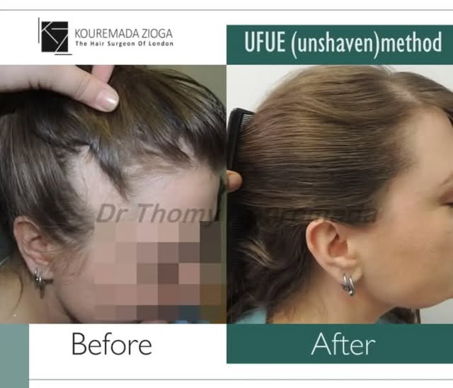 Hair Transplantation for Women — UFUE™ Unshaven Method

👉Hair loss in women can have a profound imp