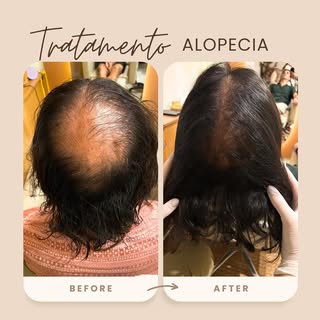 ✨TRANSFORMAÇÕES REAIS. RESULTADOS VISÍVEIS.✨

Você não precisa mais aceitar a queda capilar como par