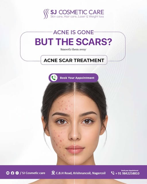 Acne might be gone, but are stubborn scars still hiding your confidence?

📍 C.B.H Road, Krishnancoi