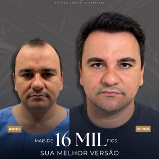 O antes e depois que fala por si. 

Neste caso, foram mais de 16 mil fios implantados para reconstru