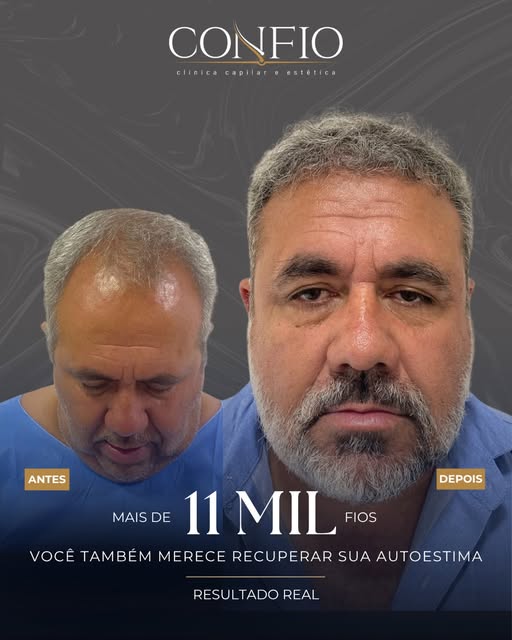 Mais do que recuperar fios, é recuperar a autoestima. 

Esse é um resultado real de transplante capi