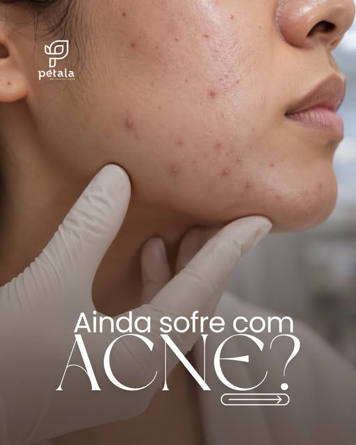 Espinhas depois dos 25? Você não está sozinha.

A acne adulta pode estar relacionada a alterações ho