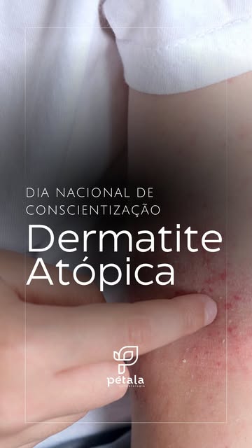 Dermatite atópica não é apenas pele seca.

A alteração da barreira da pele faz com que ela perca hid