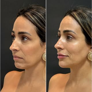 Resultado INCRÍVEL de uma paciente linda que fez o Protocolo Completo! 🤩

Não é sobre estética! É s