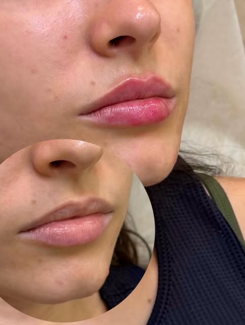 Quem mais AMA preenchimento labial? 👄💖