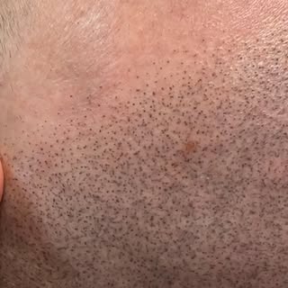 Scalp Micropigmentation at Ahead Ink in. Northern New Jersey. #scalpmicropigmentation