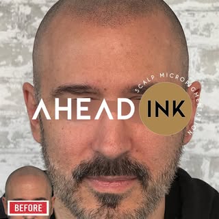 Can you get Scalp Micropigmentation if you’re not completely bald?

Absolutely—and this client is th