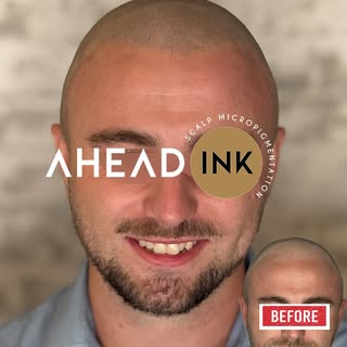 Still wearing a hat everywhere because you’re embarrassed by your hair loss? 🧢

You’re not alone.

