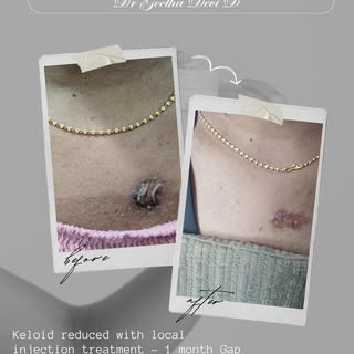 From Raised to Refined 
This is the power of precision dermatology. 💉

A stubborn keloid, treated w