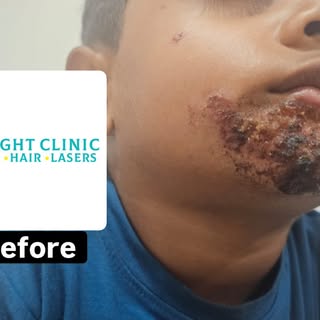 This patient came in with Impetigo — a contagious bacterial skin infection that had been persisting 