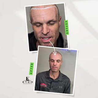Awesome results for this client. Came in wanting to restore his look following his natural hairline.