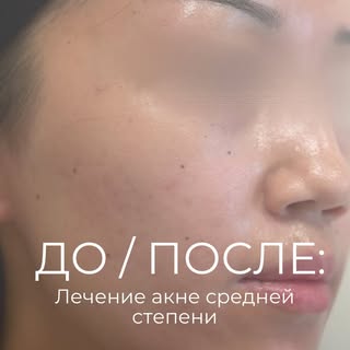 ДО И ПОСЛЕ | Лечение акне средней степени

С учетом выраженности и характера высыпаний пациентке был