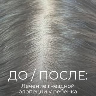 ДО И ПОСЛЕ | Лечение гнездной алопеции у ребенка

🧑🏻‍🦲 Родители пациентки обратились к нам с жало