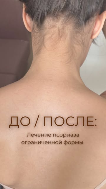 ДО И ПОСЛЕ | Лечение псориаза ограниченной формы

Псориаз ограниченной формы нередко можно спутать с