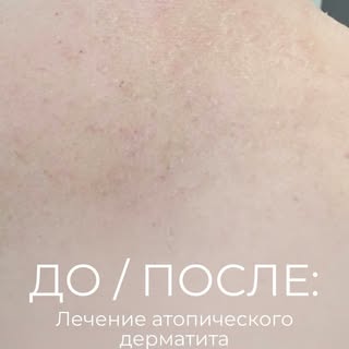 ДО И ПОСЛЕ | Лечение атопического дерматита

Атопический дерматит — хроническое воспалительное забол