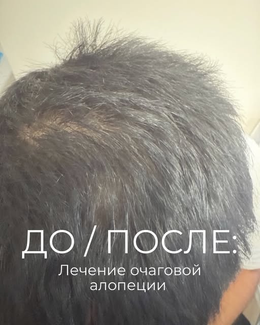ДО И ПОСЛЕ | Лечение очаговой алопеции

Пациент обратился с проблемой выпадения волос в виде круглог