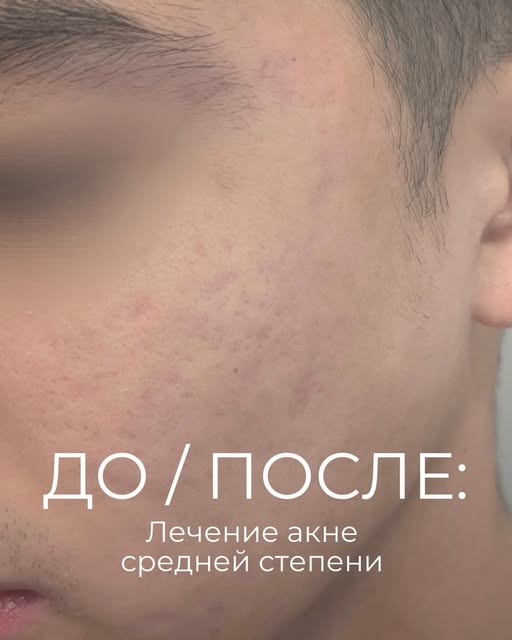 ДО И ПОСЛЕ | Лечение акне средней степени

Пациент обратился в наш центр с акне средней степени тяже