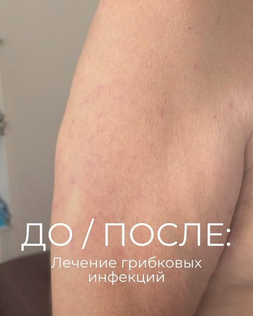 ДО И ПОСЛЕ | Лечение грибковых инфекций 

Пациент самостоятельно использовал гормональные мази, не о