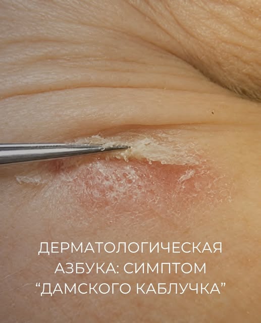 ДЕРМАТОЛОГИЧЕСКАЯ АЗБУКА | Симптом «дамского каблучка»

↪️ Читайте подробнее в этой публикации!

- -