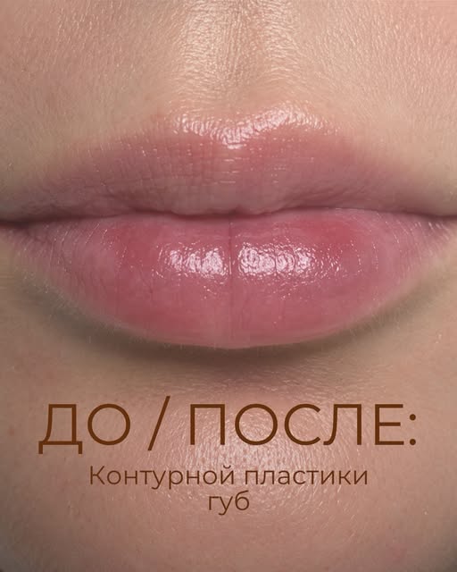 ДО И ПОСЛЕ | Контурная пластика губ 👄

Контурная пластика губ — это не обязательно про выраженное у