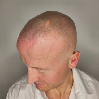 2 år helet resultat 🙌

Swipe for at se resultatet 2 år efter behandlingen 👀
Hos @copenhagenscalp e