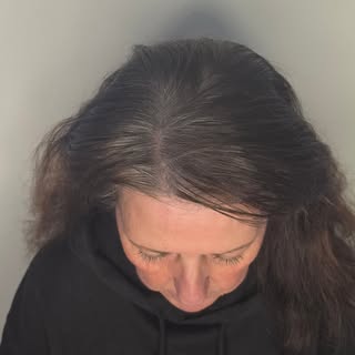Hårtab rammer ikke kun mænd — scalp micropigmentation (SMP) er også en effektiv løsning for kvinder 