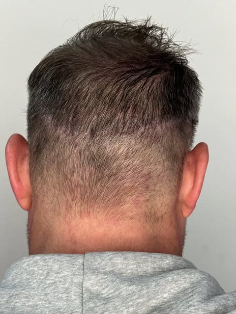 FUT-ar efter en hårtransplantation behøver ikke at være synligt. 👌

Hos Copenhagen Scalp kan vi med