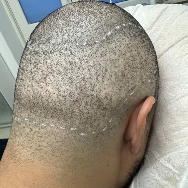 Har du FUE-ar efter en hårtransplantation?

De små ar fra en FUE-hårtransplantation kan i nogle tilf