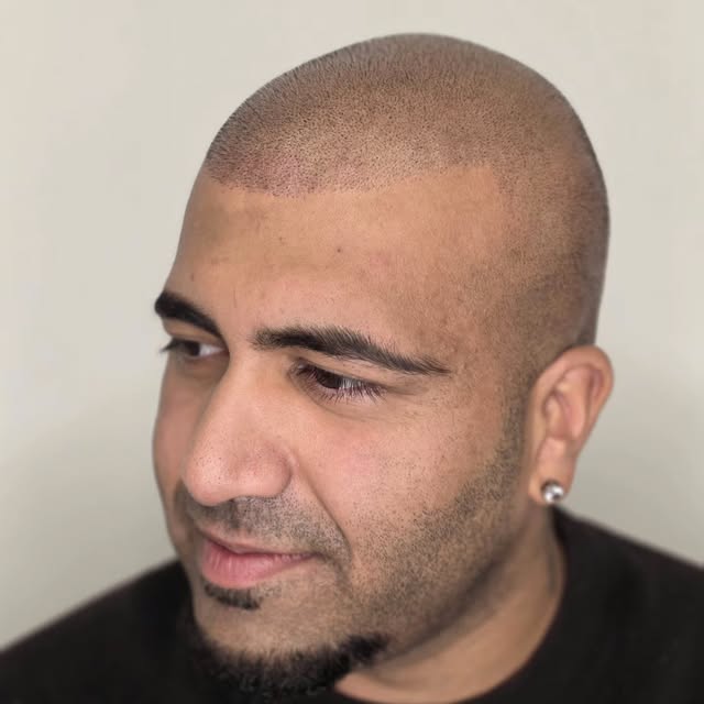 ✅ Hårtransplantation
✅ Mere fylde
✅ Naturligt resultat

Denne klient havde allerede fået foretaget e