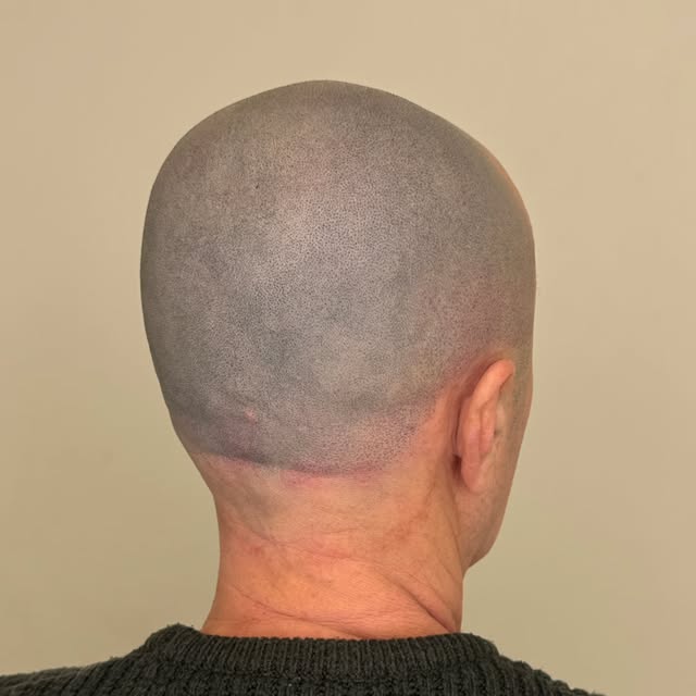 Alopecia? Du er ikke alene. ❤️

Scalp Micropigmentation (SMP) kan være en effektiv løsning for perso