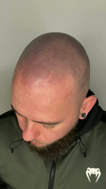 Naturlighed er nøglen. ✅

Denne klient har fået skabt en ny hårgrænse med Scalp Micropigmentation. A