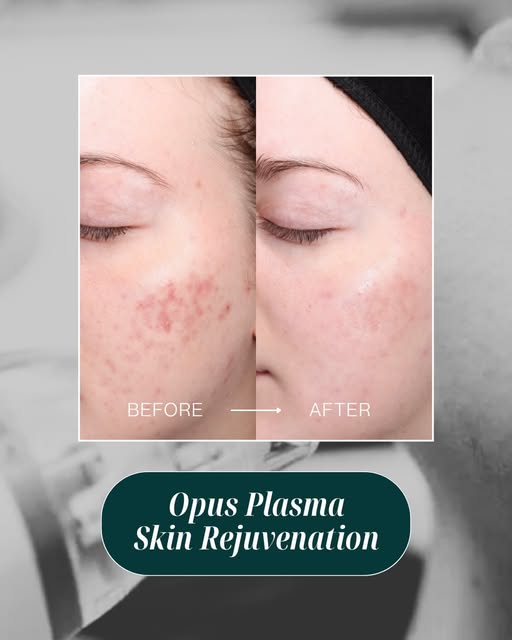 The breakout left. The texture stayed. Now what? ✨

Opus Plasma uses radiofrequency and plasma energ