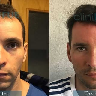 Hoy os traemos el caso de Jose Iñaki que eligió cliniFUE para hacerse un trasplante capilar. Viajó d