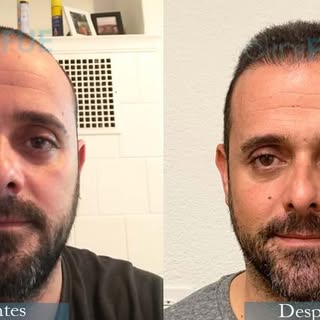 Hoy os traemos el caso de David que con 35 años no estaba dispuesto a renunciar a tener pelo. Por es