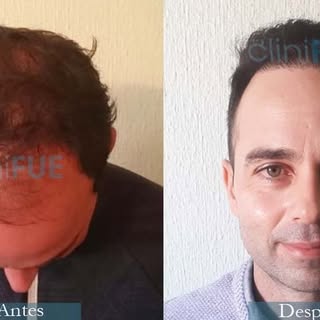 Paco decidió con 27 años viajar a Turquía desde Islas Baleares para realizarse un injerto capilar en