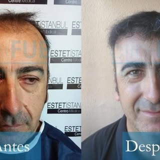 Hoy os traemos el cambio de Jose Javier que con 47 años eligió cliniFUE para hacerse un trasplante d